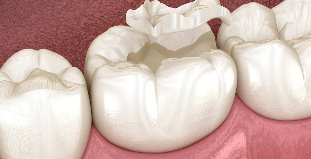 dental sealants for children, children's dental sealants, sealant application for kids, cavity prevention for children, pediatric dental sealants, protecting children's teeth, dental sealants benefits
