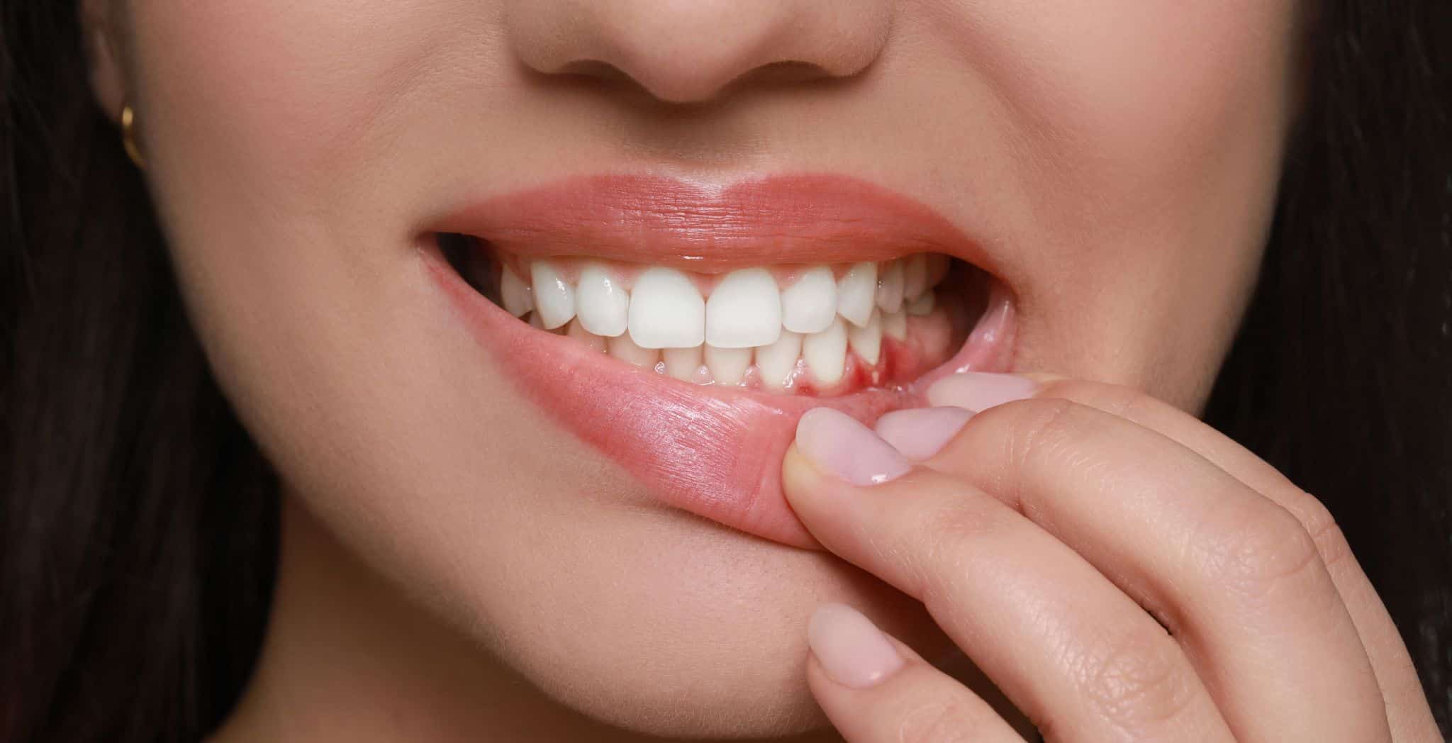 Gum disease from smoking, Smoking and periodontal disease, Effects of smoking on gums, Gum recession from smoking, Smoking and oral health, Periodontitis caused by smoking, How smoking damages gums, Gingivitis and smoking, Dental problems from smoking, Smoking and tooth loss, Oral hygiene for smokers, Smoking and gum inflammation, Quit smoking for healthy gums, Preventing gum disease from smoking, Gum health risks of smoking
