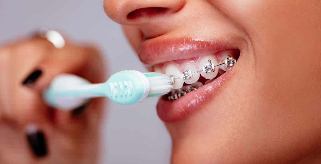 Brushing teeth with braces, How to clean teeth with braces, Braces cleaning tips, Brushing with braces guide, Proper brushing technique for braces, Tooth brushing for orthodontic patients, Maintaining oral hygiene with braces, Cleaning braces effectively, Braces care and tooth brushing, Brushing and flossing with braces, How to avoid plaque buildup with braces, Braces-friendly toothbrush tips, Brushing after meals with braces, Keeping teeth clean during orthodontic treatment, Best toothbrush for braces care, How to Brush Teeth with Braces